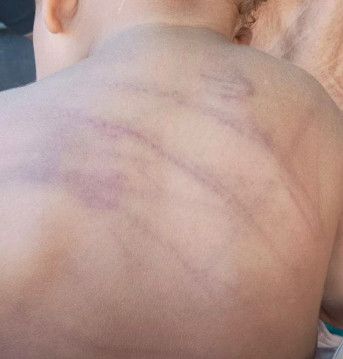Bebê de 1 ano dá entrada na UPA de Barra do Garças com sinais de agressão